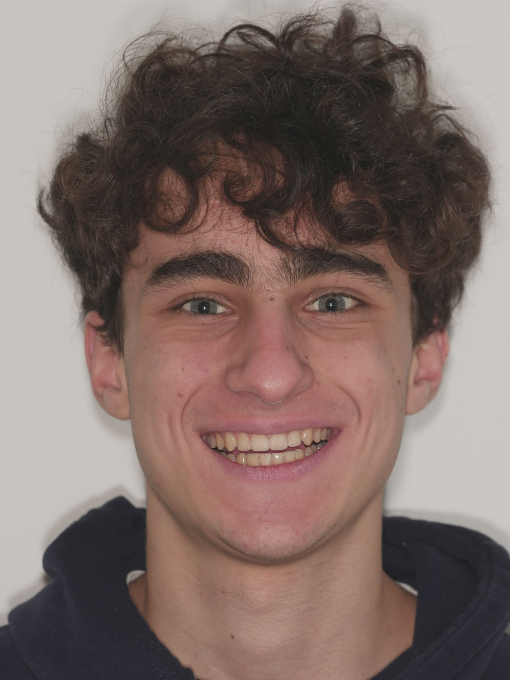 Allineatori trasparenti. Dopo il trattamento